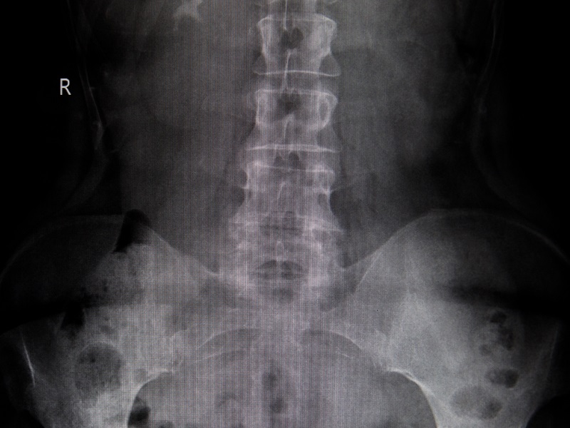 КТ попереку