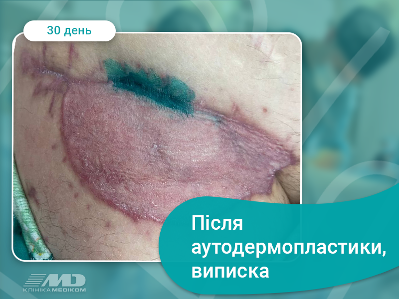 Аутодермопластика