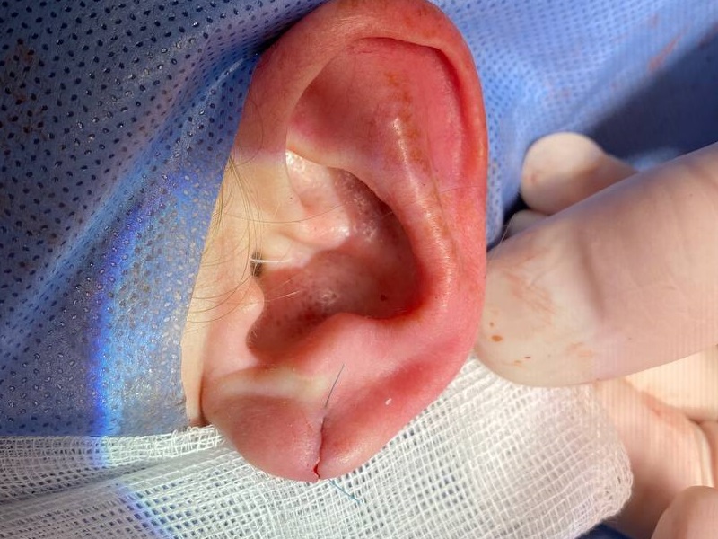 Пластика мочки вуха фото до