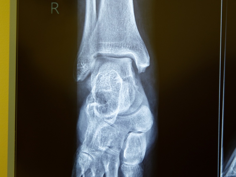 КТ гомілкостопу