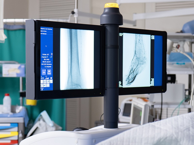 ангіопластика