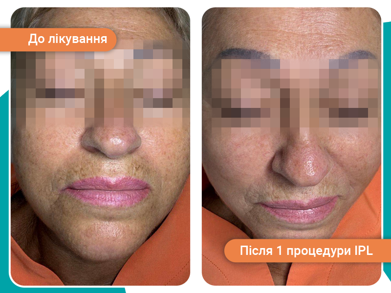 ДО пігментація лікування До пігментація лікування