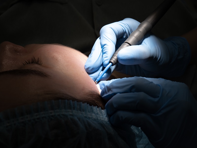 видалення родимок