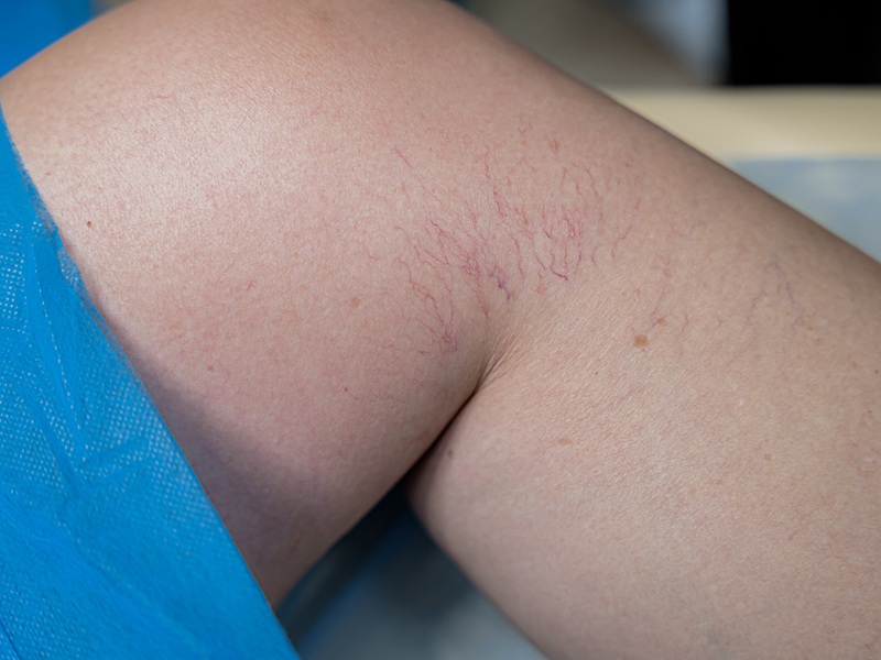 видалення судин лазером видалення судин лазером