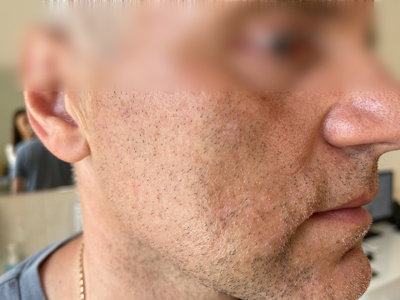 phpQmUKSB_64da1460d84b40_88231775.jpg вітилиго після