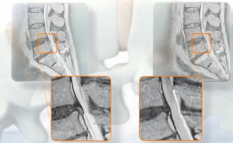 gryzha.jpg лікування грижи хребта
