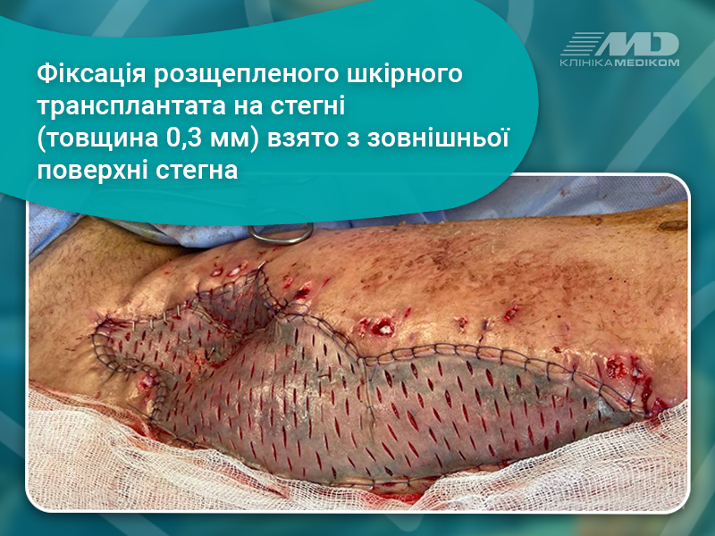 Аутодермопластика