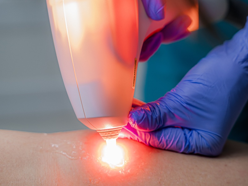 лазерне видалення судин лазерне видалення судин