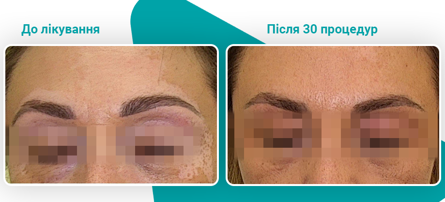 Лікування вітіліго Лікування вітіліго