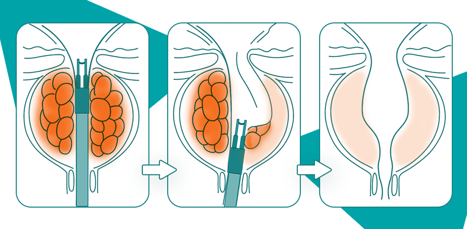 Урологія інфографіка для сайту тур простати