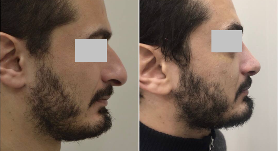 ринопластика функціональна