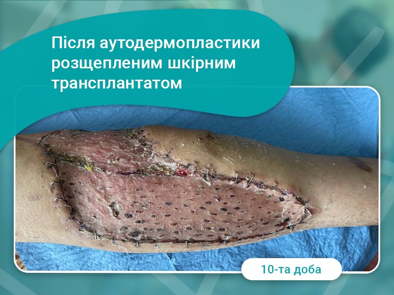 аутодермопластика