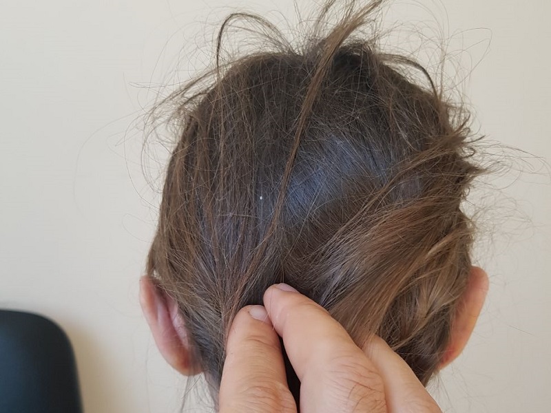 фото після отопластика