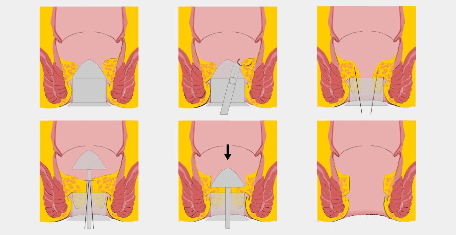 трансанальна гемороїдальна деартеріализація