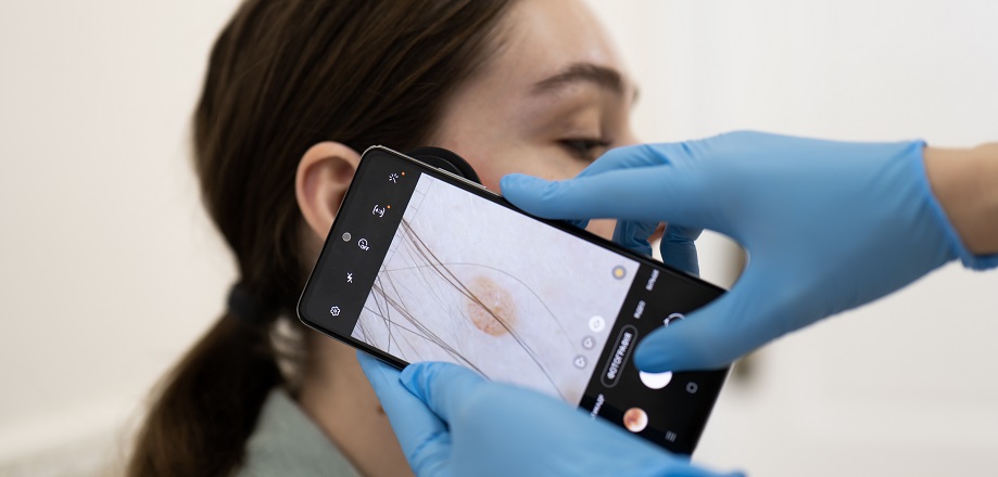 дерматоскопия невусов