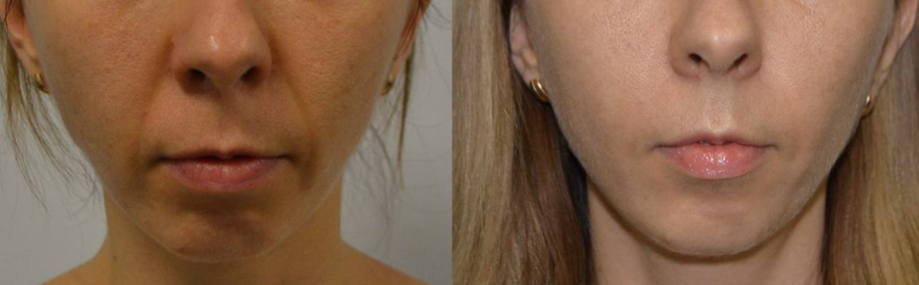 Хейлопластика