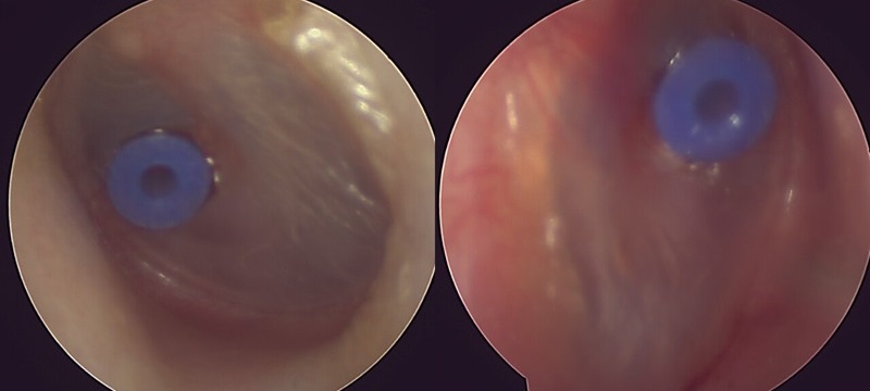 Шунт барабанної перетинки шунт барабанної перетинки